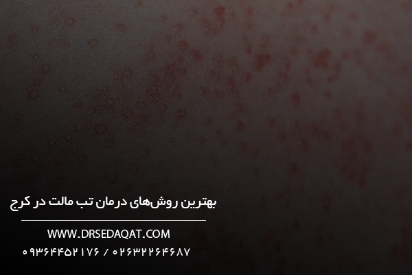 بهترین روش‌های درمان تب مالت در کرج