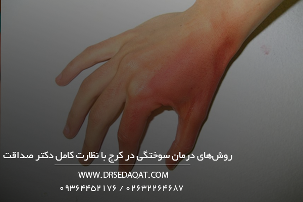 روش‌های درمان سوختگی در کرج با نظارت کامل دکتر صداقت