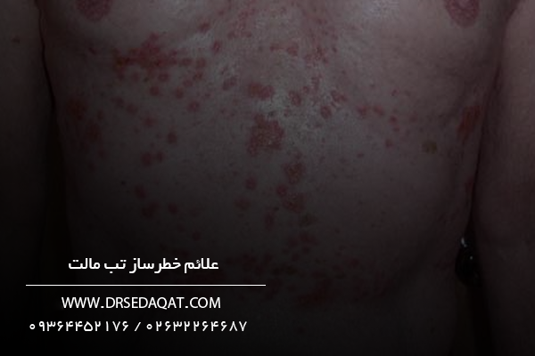 علائم-خطرساز-تب-مالت