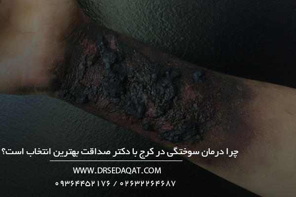 چرا درمان سوختگی در کرج با دکتر صداقت بهترین انتخاب است؟
